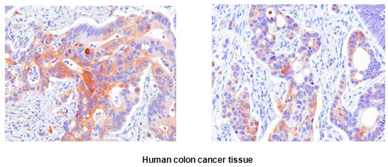 IHC-P analysis of human colon cancer using GTX57550 HSP27 antibody. Antigen retrieval: 0.1M sodium citrate buffer Dilution: 1:50