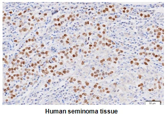 IHC-P analysis of human seminoma tissue using GTX57553 Nanog antibody. Antigen retrieval: 0.1M sodium citrate buffer Dilution: 1:50