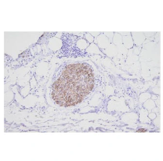 IHC-P analysis of human nerve tissue using GTX57556 PGP9.5 antibody. Antigen retrieval: 0.1M sodium citrate buffer Dilution: 1:100 IHC-P analysis of human nerve tissue using GTX57556 PGP9.5 antibody. Antigen retrieval: 0.1M sodium citrate buffer Dilution: 1:100