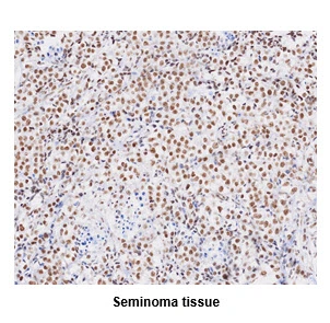 IHC-P analysis of human seminoma tissue using GTX57560 TDP43 antibody. Antigen retrieval: 0.1M sodium citrate buffer Dilution: 1:50