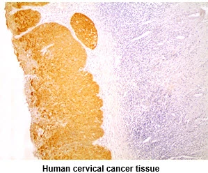 IHC-P analysis of human cervical cancer using GTX57611 Cytokeratin 14 antibody. Antigen retrieval: 0.1M sodium citrate buffer Dilution: 1:200