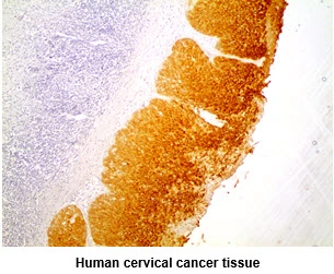 IHC-P analysis of human cervical cancer using GTX57627 Cytokeratin 5 antibody. Antigen retrieval: 0.1M sodium citrate buffer Dilution: 1:200
