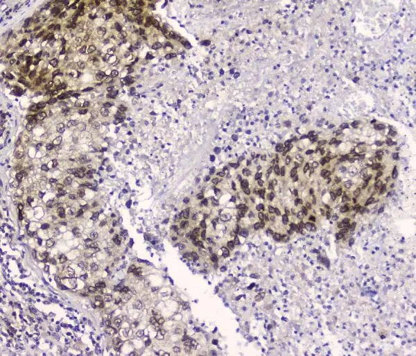 IHC-P analysis of human lung cancer tissue using GTX57736 CRM1 antibody [5G3]. Dilution : 2 microg/ml Antigen retireval : Heat mediated antigen retrieval was performed in citrate buffer (pH 6.0) for 20 mins