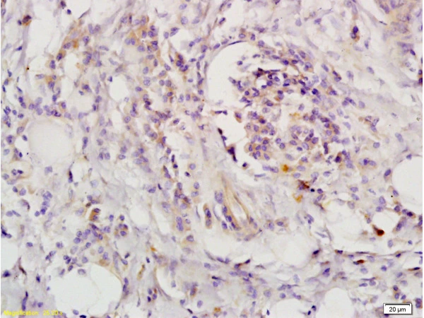 IHC-P analysis of human colon carcinoma tissue using GTX60183 LIFR antibody. Dilution : 1:200