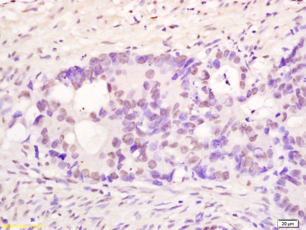 IHC-P analysis of human colon carcinoma tissue using GTX60281 PMS1 antibody. Dilution : 1:200