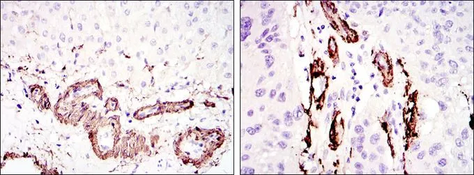 IHC-P analysis of liver tissue (left) and lung cancer tissue (right) using GTX60394 alpha Smooth Muscle Actin antibody [4F4].