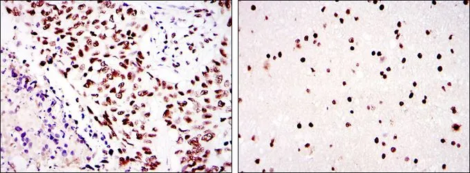 IHC-P analysis of lung cancer (left) and brain tissue (right) using GTX60401 DNA-PKcs antibody [3H6].