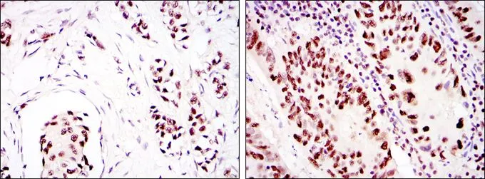 IHC-P analysis of breast cancer (left) and colon cancer (right) using GTX60401 DNA-PKcs antibody [3H6].