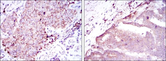 IHC-P analysis of kidney cancer tissue (left) and stomach cancer tissue (right) using GTX60414 BMPR2 antibody [1F12].