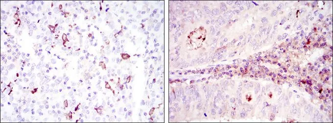 IHC-P analysis of cervical cancer tissue (left) and colon cancer tissue (right) using GTX60418 CD1a antibody [7A7].