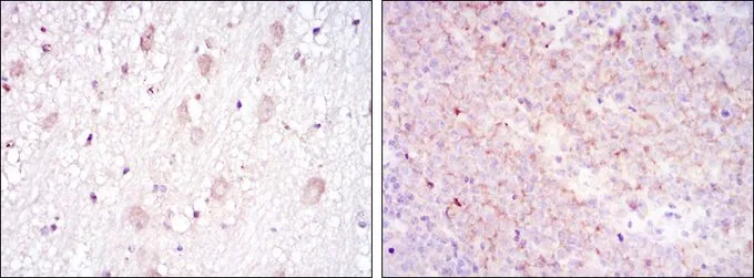IHC-P analysis of brain tissue (left) and submaxillary tumor tissue (right) using GTX60418 CD1a antibody [7A7].