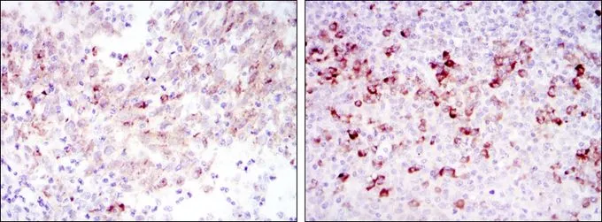 IHC-P analysis of cervical cancer tissue (left) and tonsil tissue (right) using GTX60419 Cortactin antibody [4C6].