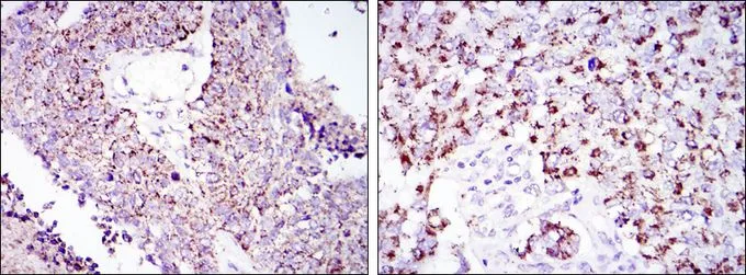 IHC-P analysis of lung cancer tissue (left) and kidney cancer tissue (right) using GTX60424 HSP60 antibody [3G8].