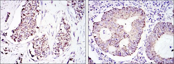 IHC-P analysis of breast cancer tissue (left) and colon cancer tissue (right) using GTX60424 HSP60 antibody [3G8].