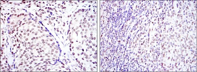 IHC-P analysis of prostate cancer tissue (left) and submaxillary tumor tissue (right) using GTX60431 CREB antibody [5G3].
