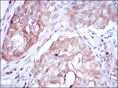 IHC-P analysis of lung cancer using GTX60435 MTHFR antibody [5D3].