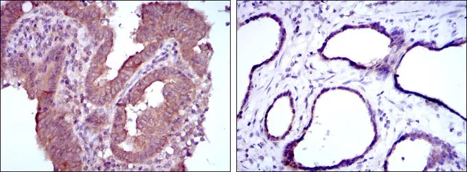 IHC-P analysis of intima cancer tissue (left) and prostate tissue (right) using GTX60435 MTHFR antibody [5D3].