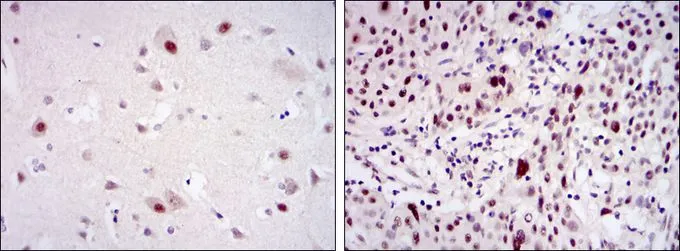 IHC-P analysis of human brain tissue (left) and esophageal cancer tissue (right) using GTX60442 CDK9 antibody [1B5A7].