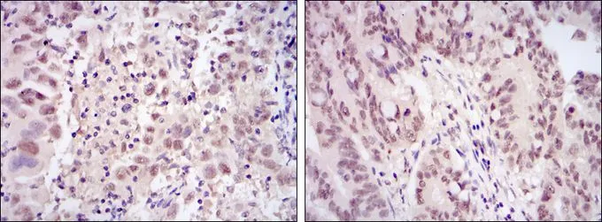 IHC-P analysis of endometrial cancer tissue (left) and rectum cancer tissue (right) using GTX60443 CDK9 antibody [1B5D10].