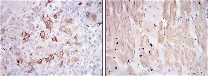 IHC-P analysis of breast cancer tissue (left) and cardiac muscle tissue (right) using GTX60444 HSP27 antibody [5D7].