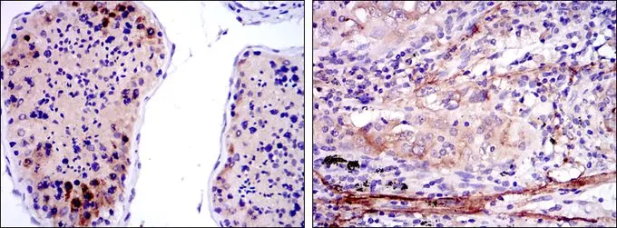 IHC-P analysis of testis tissue (left) and lung cancer tissue (right) using GTX60451 SMN1 antibody [2F1].