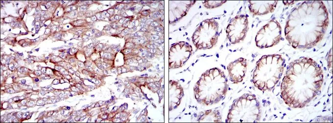 IHC-P analysis of stomach cancer tissue (left) and stomach tissue (right) using GTX60457 Cytokeratin 19 antibody [1H6].