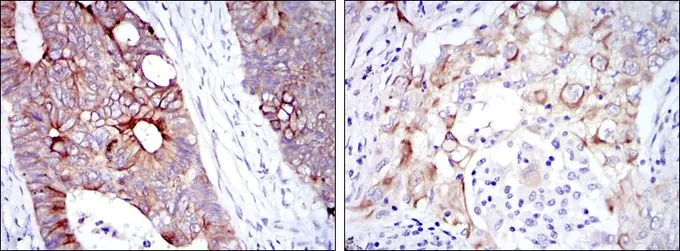 IHC-P analysis of rectum cancer tissue (left) and lung cancer tissue (right) using GTX60457 Cytokeratin 19 antibody [1H6].