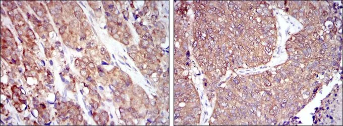 IHC-P analysis of prostate cancer tissue (left) and lung cancer tissue (right) using GTX60459 HSP90 beta antibody [1D9].
