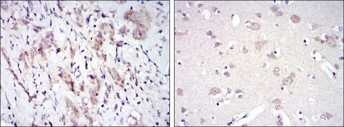 IHC-P analysis of breast cancer tissue (left) and brain tissue (right) using GTX60460 FYN antibody [2A10].