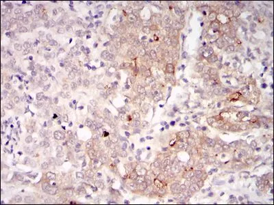 IHC-P analysis of human cervical cancer tissue using GTX60463 BLNK antibody [5G9].
