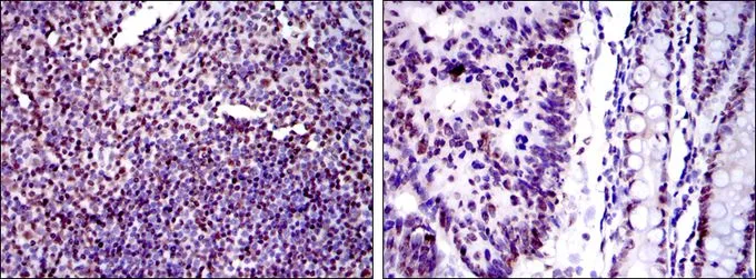 IHC-P analysis of human tonsil tissue (left) and human colon cancer tissue (right) using GTX60468 Ku80 antibody [5C5].