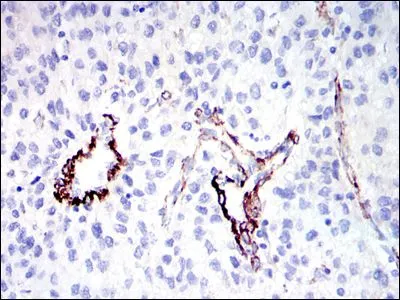 IHC-P analysis of human liver cancer tissue using GTX60469 DLGAP1 antibody [3G4].
