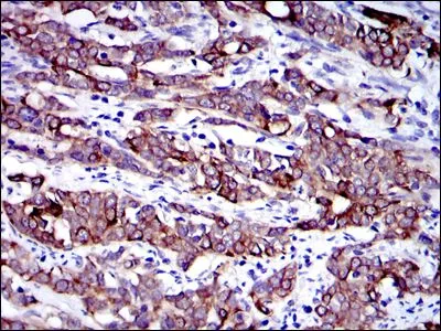 IHC-P analysis of human cervical cancer tissue using GTX60480 Cytokeratin 19 antibody [4E8].
