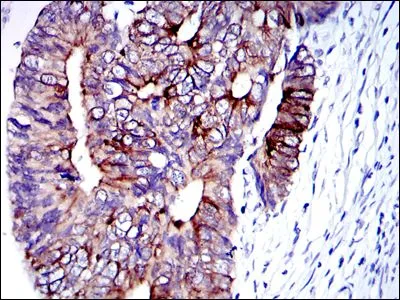 IHC-P analysis of human colon cancer tissue using GTX60480 Cytokeratin 19 antibody [4E8].