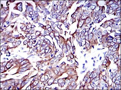 IHC-P analysis of human stomach cancer tissue using GTX60480 Cytokeratin 19 antibody [4E8].