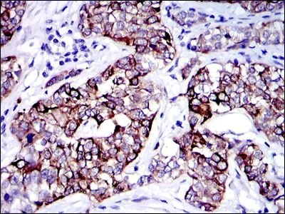 IHC-P analysis of human bladder cancer tissue using GTX60480 Cytokeratin 19 antibody [4E8].