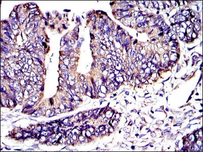 IHC-P analysis of rectum cancer tissue using GTX60487 CRK antibody [3G11C1].