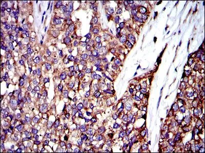 IHC-P analysis of bladder cancer tissue using GTX60487 CRK antibody [3G11C1].