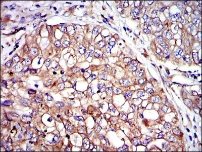 IHC-P analysis of lung cancer tissue using GTX60488 CRK antibody [3G11E8].