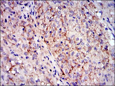 IHC-P analysis of gastrointestinal stromal tumor using GTX60490 c-Kit antibody [1C5].