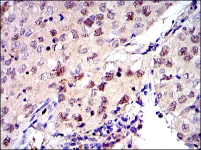 IHC-P analysis of lung cancer tissue using GTX60491 MCM2 antibody [2B3].
