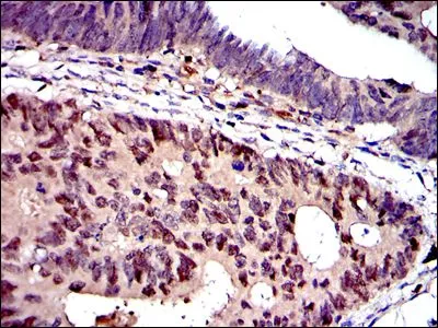 IHC-P analysis of colon cancer tissue using GTX60491 MCM2 antibody [2B3].