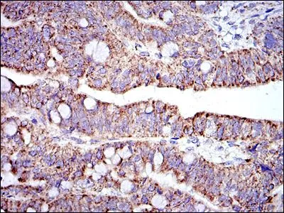 IHC-P analysis of rectum cancer tissue using GTX60495 Prohibitin antibody [5H7].
