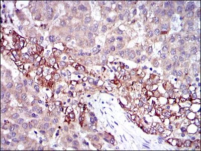 IHC-P analysis of liver cancer tissue using GTX60502 Fibrinogen gamma antibody [4H9].