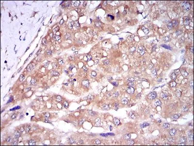 IHC-P analysis of liver cancer tissue using GTX60510 Caspase 8 antibody [1H11].