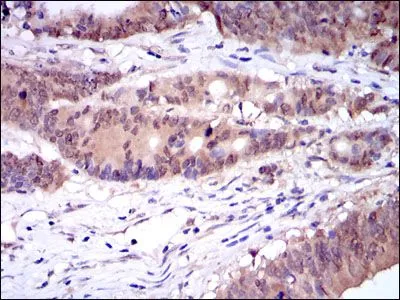 IHC-P analysis of colon cancer tissue using GTX60510 Caspase 8 antibody [1H11].