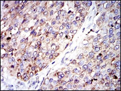 IHC-P analysis of kidney cancer tissue using GTX60518 G6PD antibody [2H7].