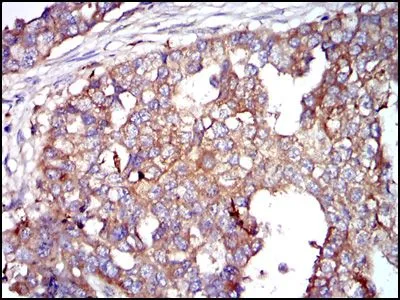 IHC-P analysis of breast cancer tissue using GTX60518 G6PD antibody [2H7].
