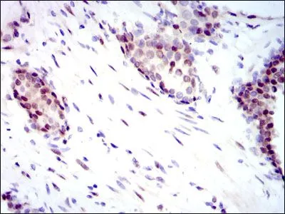IHC-P analysis of prostate cancer tissue using GTX60554 YAP1 antibody [1A12].