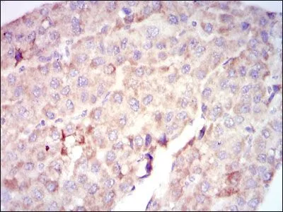IHC-P analysis of liver cancer tissue using GTX60556 Raf1 antibody [4G4].
